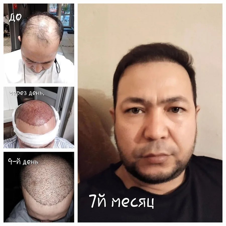 Этапы после пересадки: до операции, через день, на 9-й день и через 7 месяцев